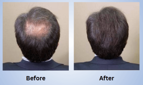 Revifol-Before-and-After